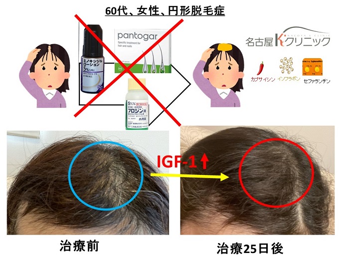 円形脱毛症　病院